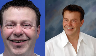 Drs. Kenneth   Robin Rawlinson, LLC | Preventative Program, Invisalign reg  and Dental Bridges