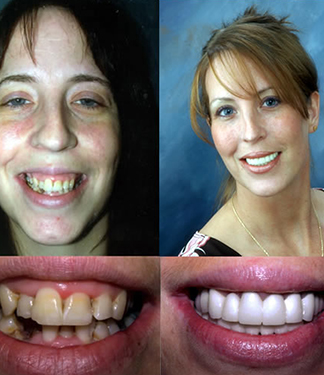 Drs. Kenneth   Robin Rawlinson, LLC | Teeth Whitening, Preventative Program and Veneers