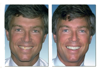 Drs. Kenneth   Robin Rawlinson, LLC | Invisalign reg , Veneers and Dental Bridges