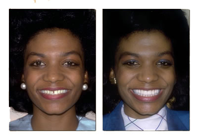 Drs. Kenneth   Robin Rawlinson, LLC | Invisalign reg , Dental Fillings and Veneers