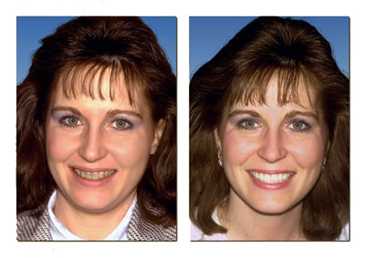 Drs. Kenneth   Robin Rawlinson, LLC | Preventative Program, Veneers and Crowns