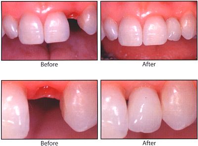 Drs. Kenneth   Robin Rawlinson, LLC | Veneers, Teeth Whitening and Extractions