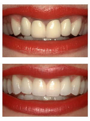 Drs. Kenneth   Robin Rawlinson, LLC | Dental Bridges, Sleep Apnea and Crowns