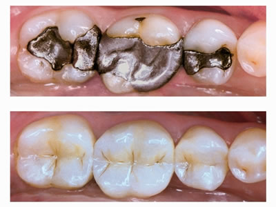 Drs. Kenneth   Robin Rawlinson, LLC | Extractions, Periodontal Treatment and Invisalign reg 
