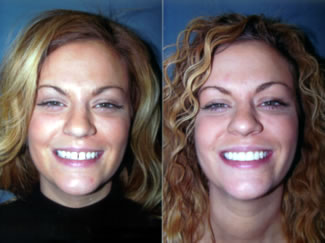 Drs. Kenneth Robin Rawlinson, LLC | Preventative Program, Invisalign reg and Crowns