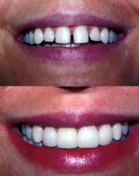 Drs. Kenneth Robin Rawlinson, LLC | Oral Exams, Veneers and Dentures