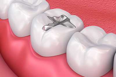 Drs. Kenneth   Robin Rawlinson, LLC | Dental Fillings, Invisalign reg  and Dental Bridges
