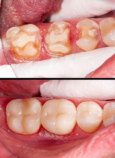 Drs. Kenneth   Robin Rawlinson, LLC | Periodontal Treatment, Oral Exams and Dentures