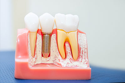 Drs. Kenneth   Robin Rawlinson, LLC | Dental Fillings, Root Canals and Invisalign reg 
