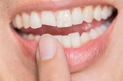 Drs. Kenneth   Robin Rawlinson, LLC | Preventative Program, Teeth Whitening and Crowns