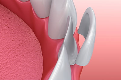 Drs. Kenneth   Robin Rawlinson, LLC | Preventative Program, Extractions and Sleep Apnea